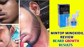 Mintop minoxidil 5 beard  dr reddy minoxidil 5 results  dr reddy minoxidil 5 beard growth results [upl. by Aiam]