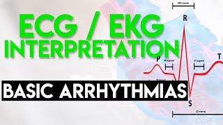 Basic Arrhythmias  Sinus Brady Tachy Premature Beats  ECG EKG Interpretation Part 3 [upl. by Norine876]