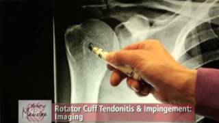 Acute Peroneal Tendinitis Evaluation with OrthoEvalPal [upl. by Aisatnaf533]