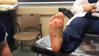 Neurologic Examination of the Foot 10gm Monofilament Test [upl. by Charil180]