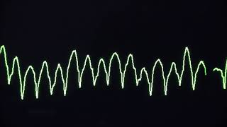 Cardiac arrest rhythms VF VT Asystole and PEA [upl. by Crompton31]