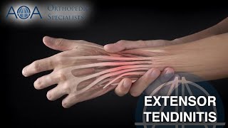 De Quervains tenosynovitis surgery recovery [upl. by Enomar]