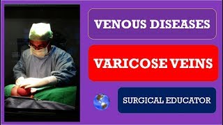 Varicose Vein Symptoms and Signs [upl. by Phillips]